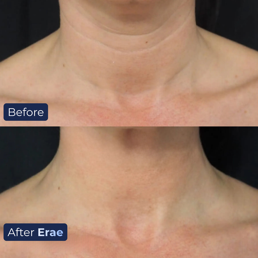 Erae™ Bio-Infusion