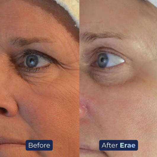 Erae™ Bio-Infusion
